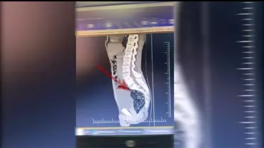 Midesinde bulunan metamfetamin paketleri