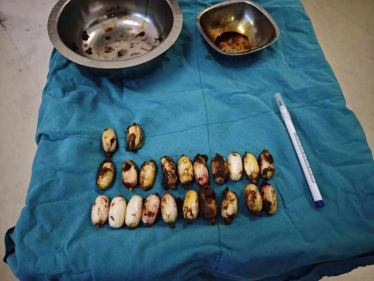 Eskişehir’de Mide İçinden Çıkarılan 44 Uyuşturucu Kapsülü Olayı