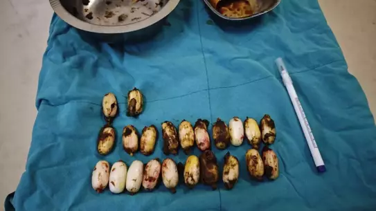 Mideden çıkarılan 44 uyuşturucu kapsülü