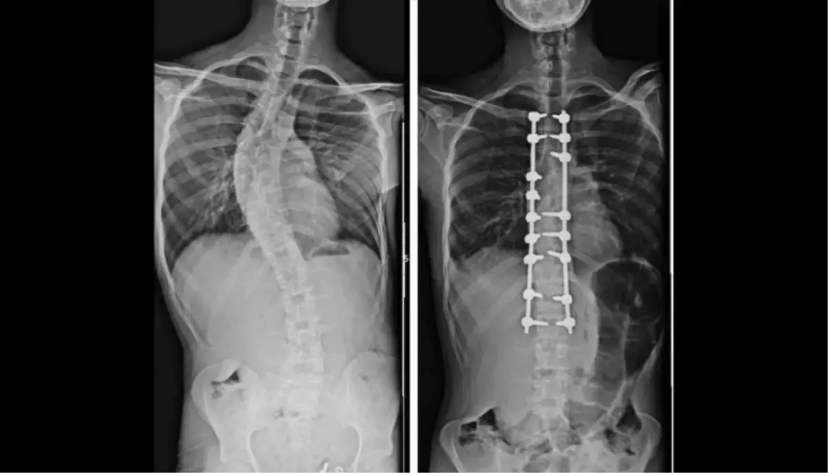 Yapay Zeka ve Robotik Ortopedi: OMÜ'den Çığır Açan Yaklaşımlar