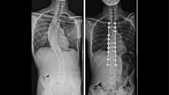 Yapay zeka destekli ortopedi cerrahisi