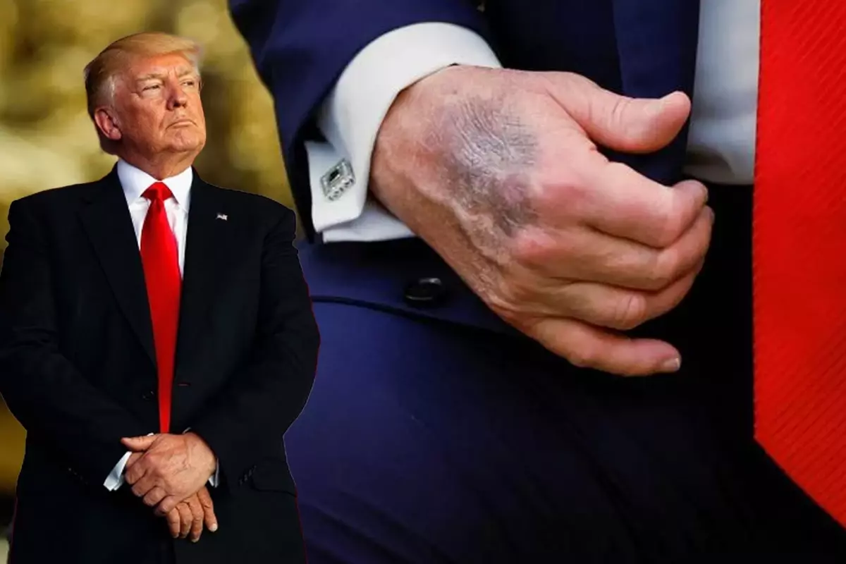 Trump'ın Morarmış Eli Açıklandı: Masaya Çarptı, Aspirin Kullanıyor