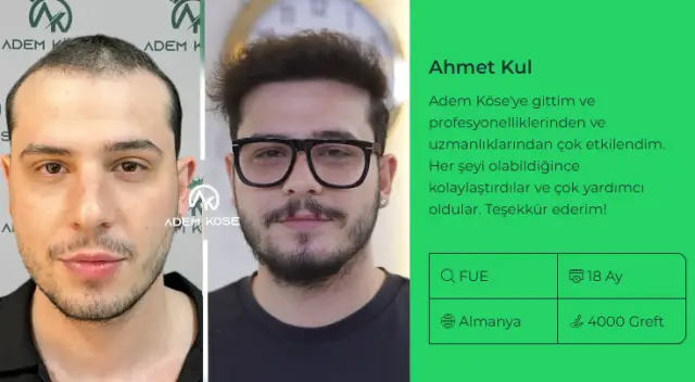 Saç ekimi sonrası doğal sonuç örneği