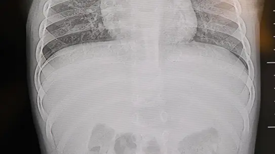 Kahramanmaraş'ta 1 Yaşındaki Bebekten 2 cm Uzunluğunda Zımba Teli Çıkarıldı