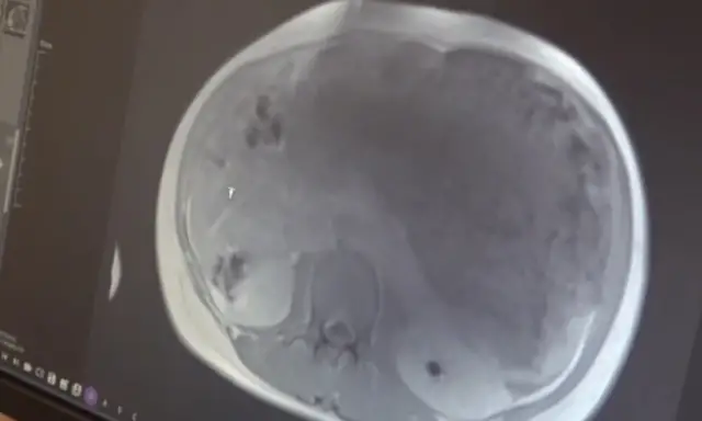 Operasyon sonrası hastanın durumu