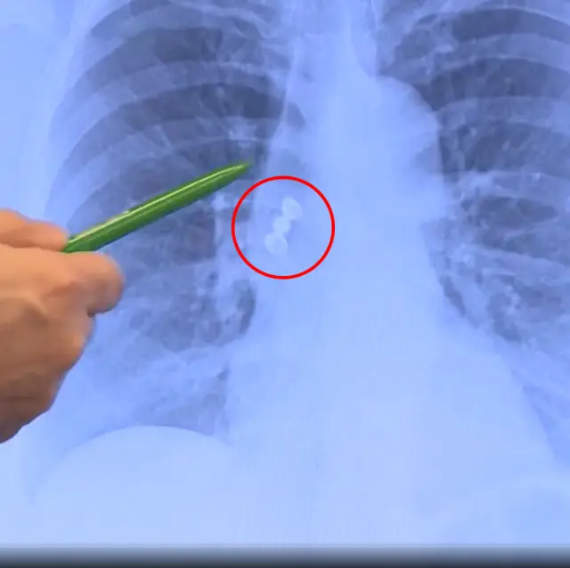 Bronkoskopi ekipmanları