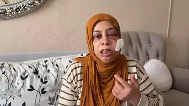 İskenderun’da Kırık Rögar Kapağına Düşen Kadının Yüzüne 14 Dikiş Atıldı