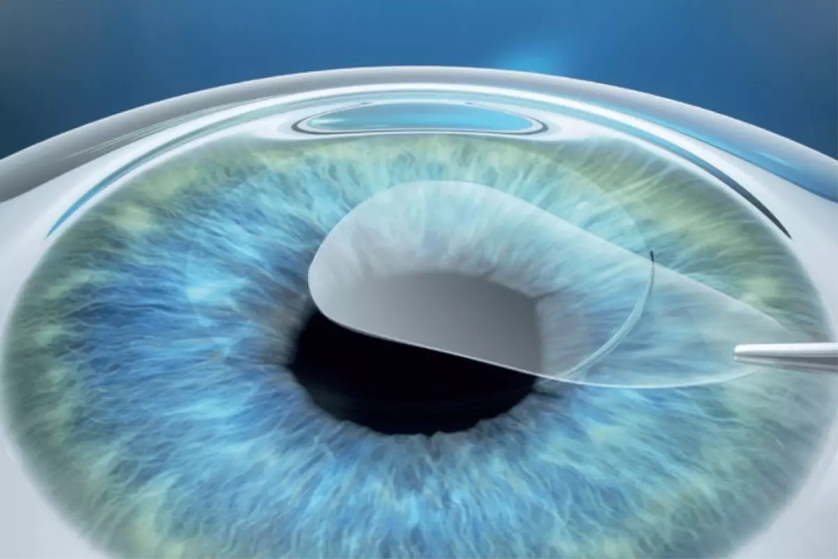 Sağlam Kornea Üzerinde Göz Damlalarının Penetrasyonu İlk Defa Gerçek Zamanlı Ölçüldü