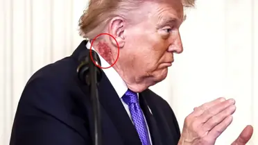 Trump'ın boynundaki kızarıklık fotoğrafı