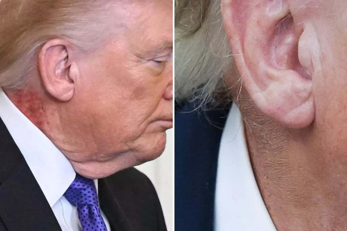 Trump, Almanya Şansölyesi Görüşmesi Sırasında Boyun Kızarıklığını Makyajla Gizlemeye Çalıştı