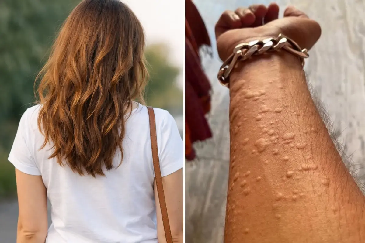 Kadın, Erkek Arkadaşını Ziyaret Ettikten Sonra Cildinde Beliren Kızarıklıklar İçin Yardım İstedi