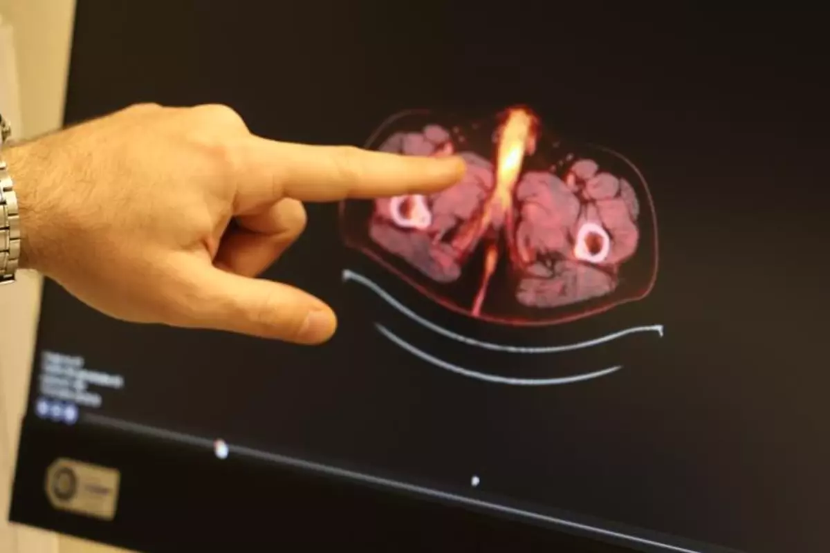 Diyarbakır'da Kolon Kanseri Tedavisi Sırasında Peniste Oluşan Kitle: Uzuv Kaybı Riski ve Erken Tanı Önemi