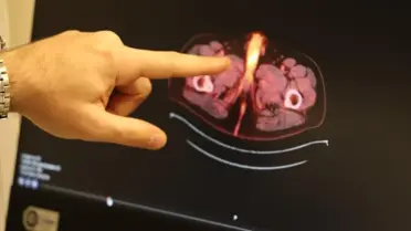 Diyarbakır'da Kolon Kanseri Tedavisi Sırasında Peniste Oluşan Kitle: Uzuv Kaybı Riski ve Erken Tanı Önemi