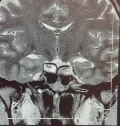 Doktorun önerdiği yaşam tarzı değişiklikleri