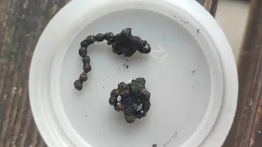 Rize'de 5 Yaşındaki Kız Çocuğunun Burnundan Zincir Çıkarıldı