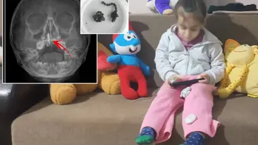 Rize’de 5 Yaşındaki Kızın Burununda Yıllarca Gizli Kalan Zincir Çıkarıldı