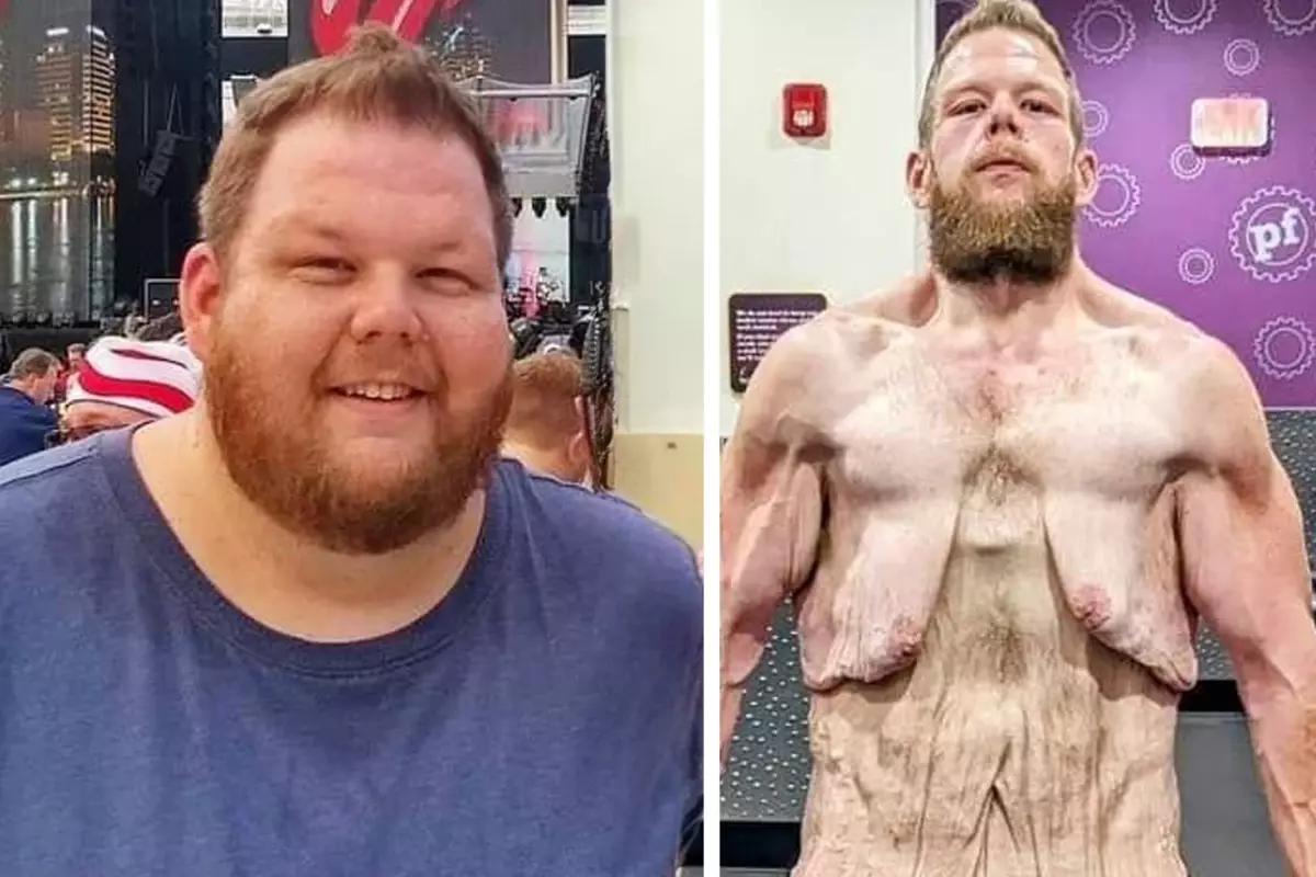 163 kilo kaybı sonrası deri ameliyatı masrafları için yardım çağrısı