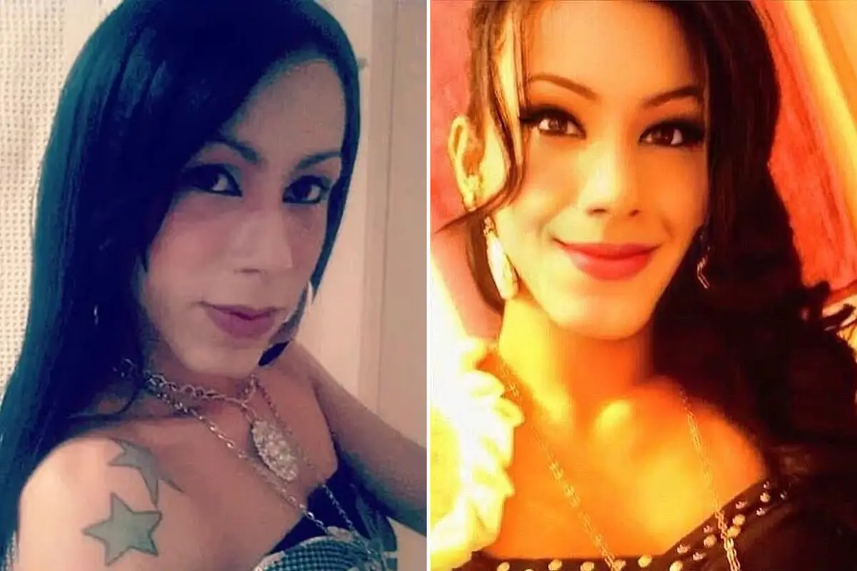 Brezilya’da Estetik Operasyon Kabusu: Yanlış Dolgu Sonrası Ağır Deformasyon