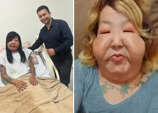 Operasyon sonrası yüz deformasyonu