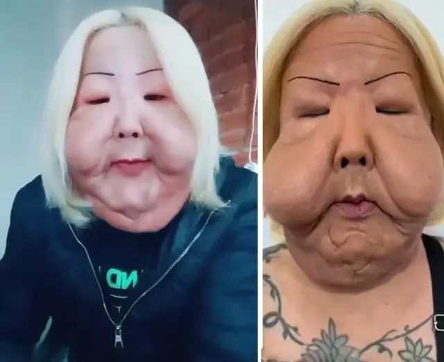 Estetik cerrahi sonrası iyileşme süreci