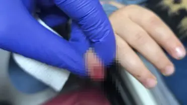 Kızıltepe’de 3 Yaşındaki Çocuğun Parmağı Merdivende Kaldı: Olayın Detayları