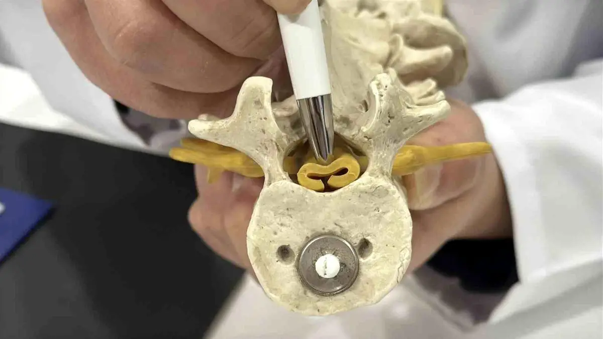 Omurga Daralması: Belirtileri, Riskleri ve Etkili Tedavi Yöntemleri