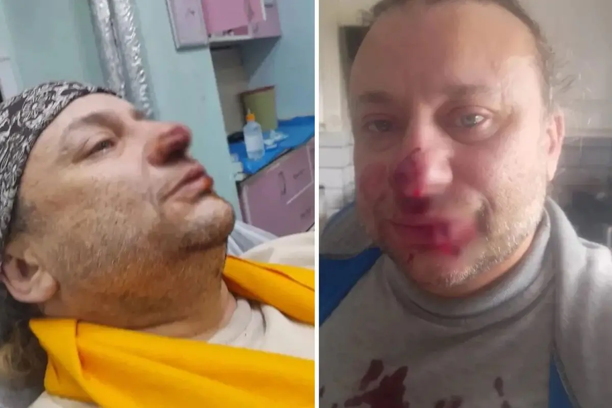 Ünlü şarkıcı Onur Akay, sokakta pitbull saldırısına maruz kaldı