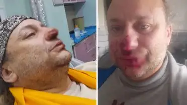 Ünlü şarkıcı Onur Akay, sokakta pitbull saldırısına maruz kaldı