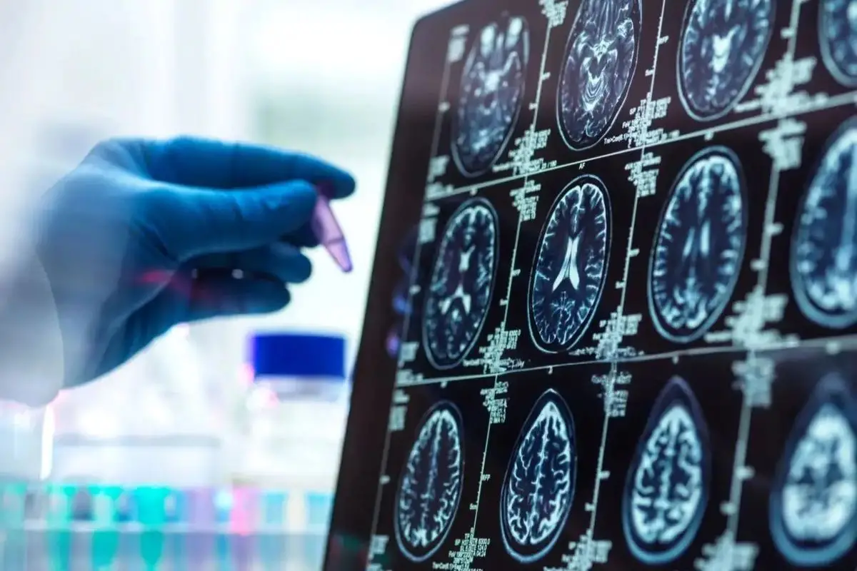 Alzheimer Hastalığının Erken Biyobelirteçleri Belirlendi: Belirtiler Öncesi Değişimler Açıklandı