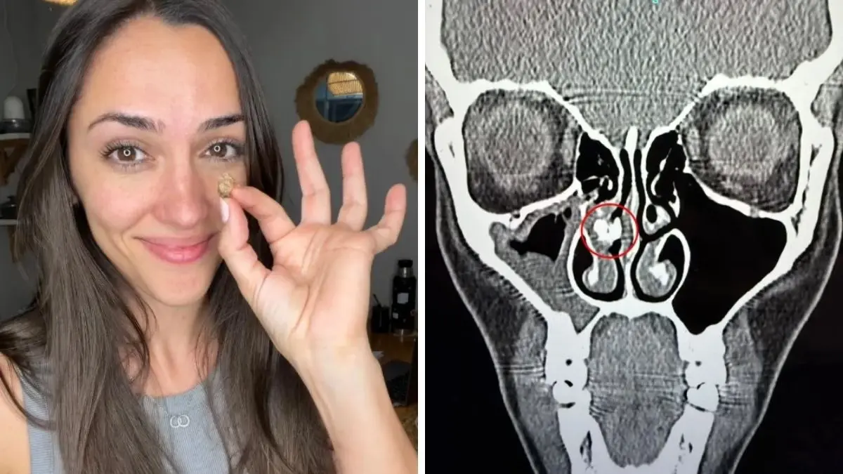 35 Yıl Sonra Ortaya Çıkan Gerçek: Burnundan Çıkan Şeye Kimse İnanamadı!