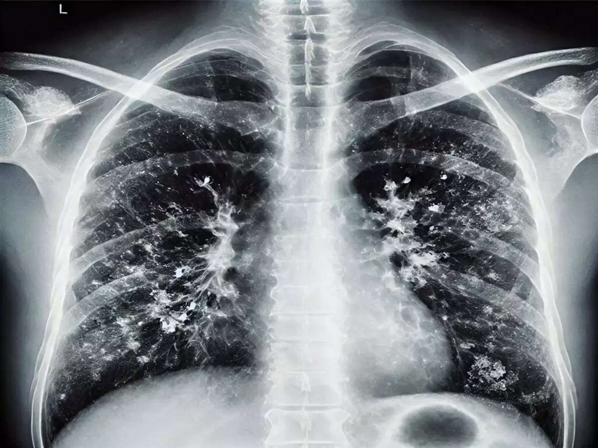 Gribal Enfeksiyon ve Süperenfeksiyon Uyarısı