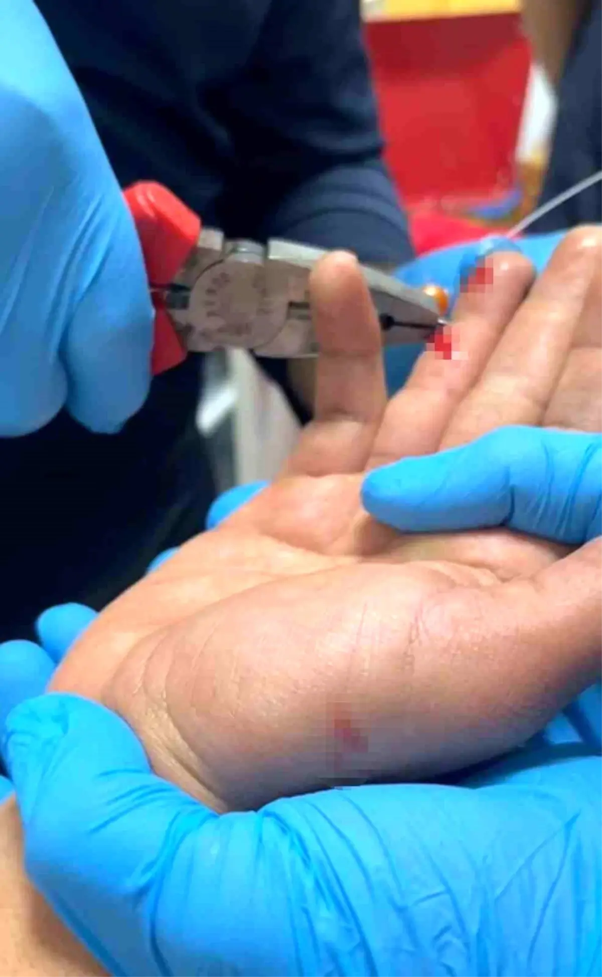 Kahta’da Balık Avında İğne Faciası