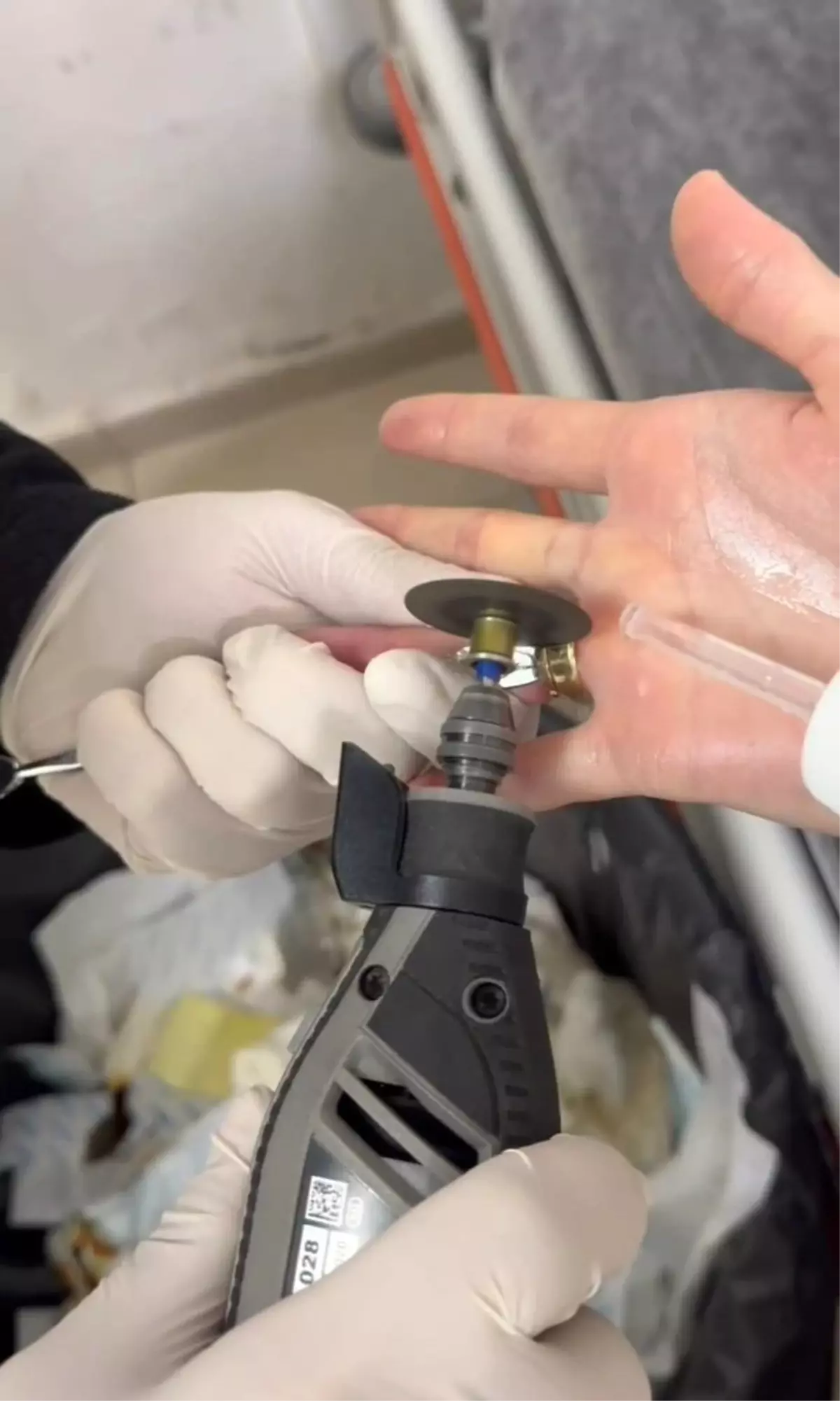 Batman’da Parmağa Sıkışan Yüzükler Kurtarıldı