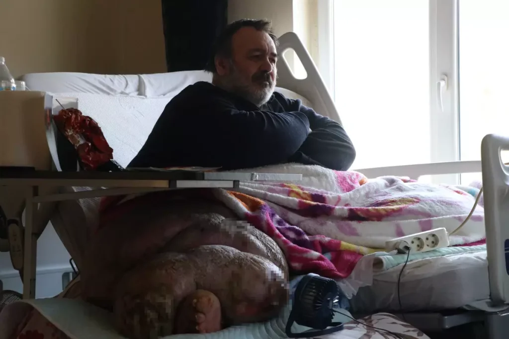 Fil Hastalığına Tedavi Başlıyor: Kayseri’de Engin Akbadal’a Umut Işığı