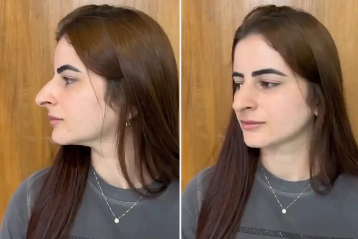 Hevesle Burun Estetiği Oldu Ama Sonu Skandal