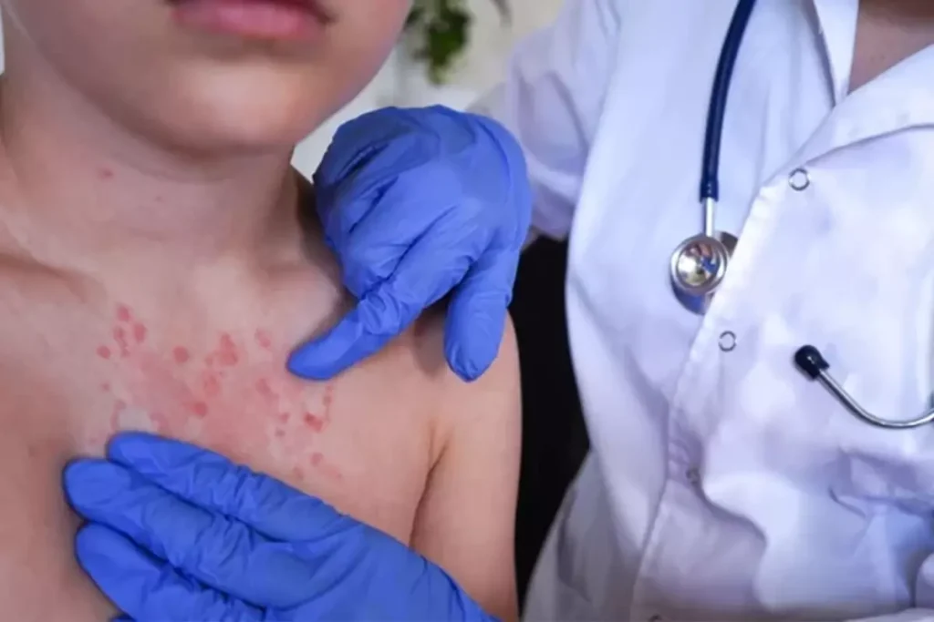 Vakalar Son 30 Yılda Pik Yaptı! İki Haftada Ortaya Çıkıyor, 3 Yıl Kadar Sürüyor