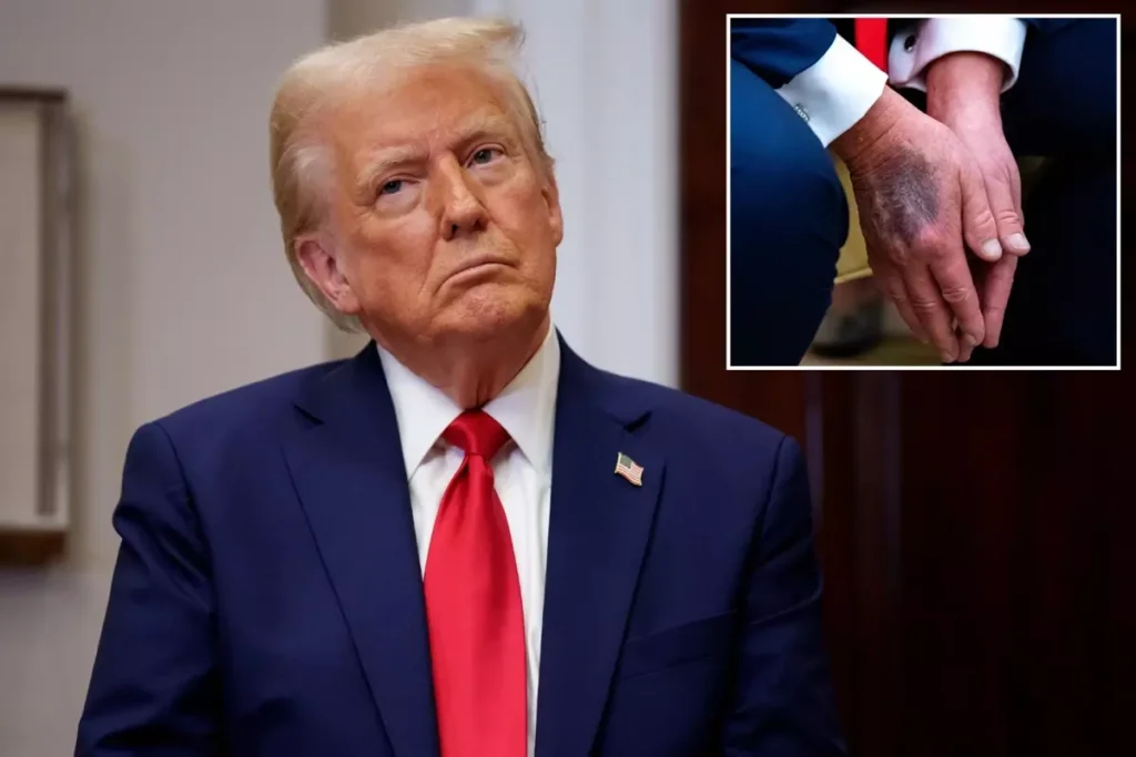 Trump elindeki morlukların nedenini ilk kez açıkladı